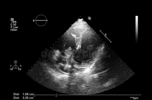 影像关于指已提到的人<strong>心</strong>在的时候经食道的超声.