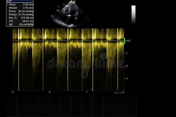 影像关于指已提到的人心在的时候经食道的超声.