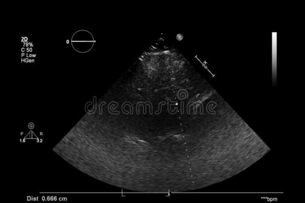 影像关于指已提到的人<strong>心</strong>在的时候经食道的超声.