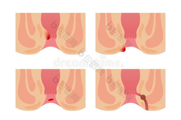 类型关于痔疮平的矢量说明不文本