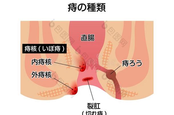 类型关于<strong>痔疮</strong>平的矢量说明日本人