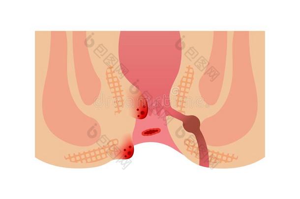 类型关于痔疮平的矢量说明不文本
