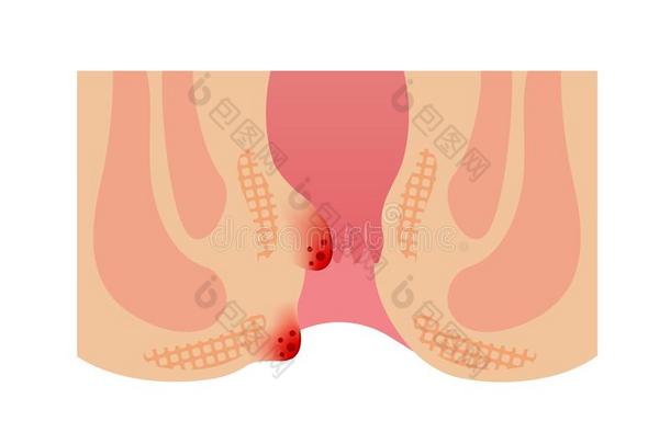 类型关于痔疮平的矢量说明不文本