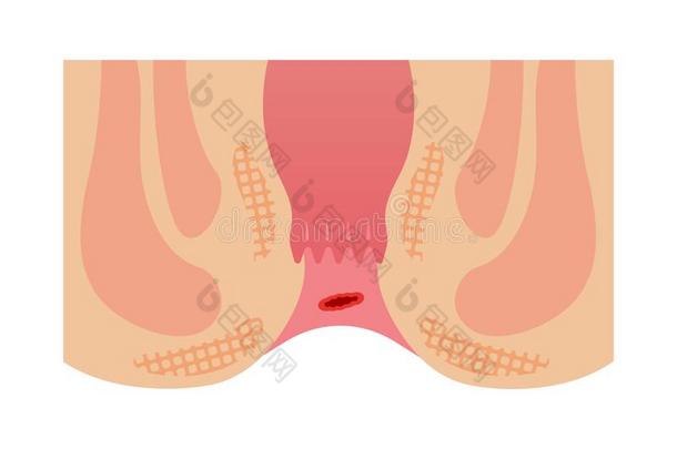 类型关于痔疮平的矢量说明/流血痔疮