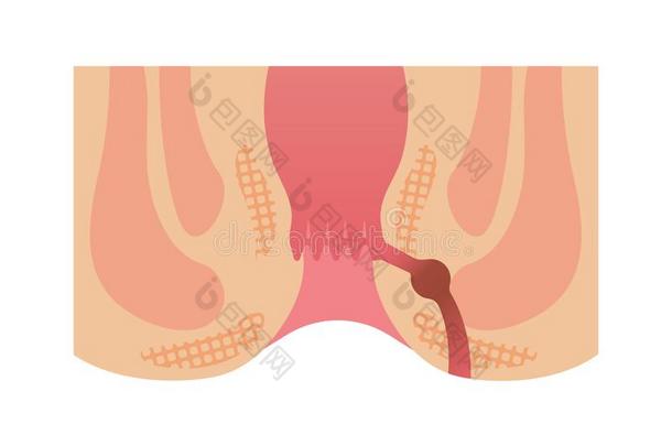 类型关于痔疮平的矢量说明/肛门的瘘