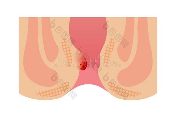 类型关于痔疮平的矢量说明/国内的痔疮