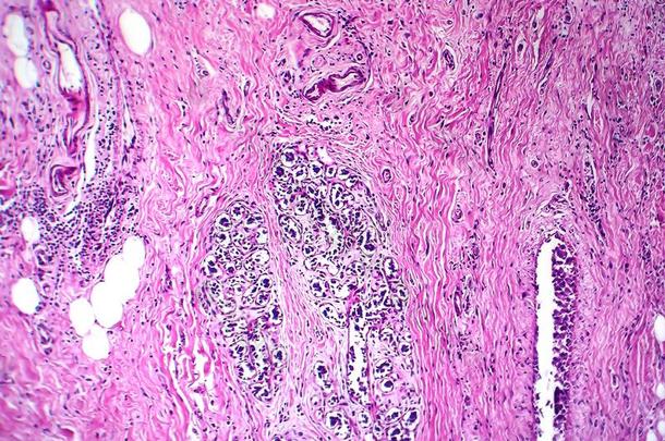 乳房管的癌,光显微图
