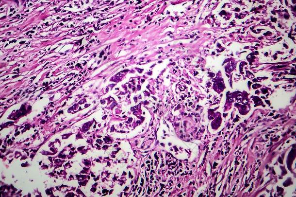 乳房管的癌,光显微图