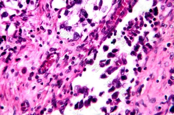 睾丸精原细胞瘤,光显微图
