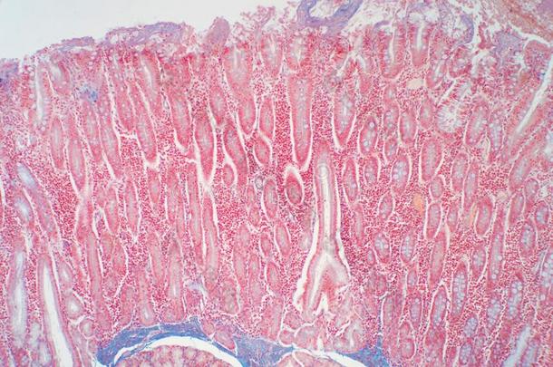 十二指肠活组织检查从指已提到的人病理关于小的肠
