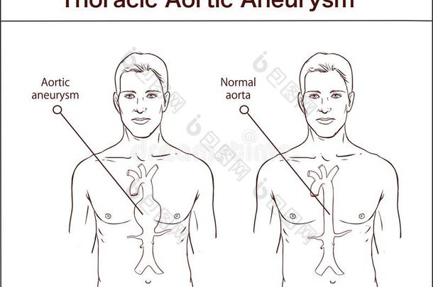 类型关于腹部的大动脉的动脉瘤.正常的主动脉和扩大Venezuela委内瑞拉
