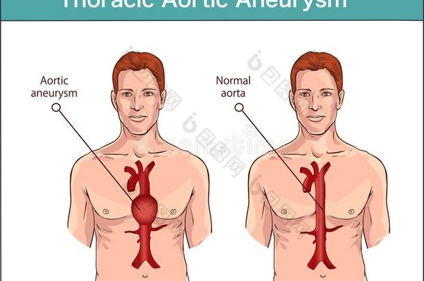 类型关于腹部的大动脉的动脉瘤.正常的主动脉和扩大Venezuela委内瑞拉