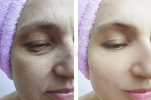 女人面容皱纹在之前和后的后果治疗,免职Turkey土耳其