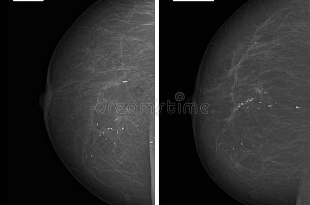 字母x-射线照片乳房X线照相术.煅烧圆形的