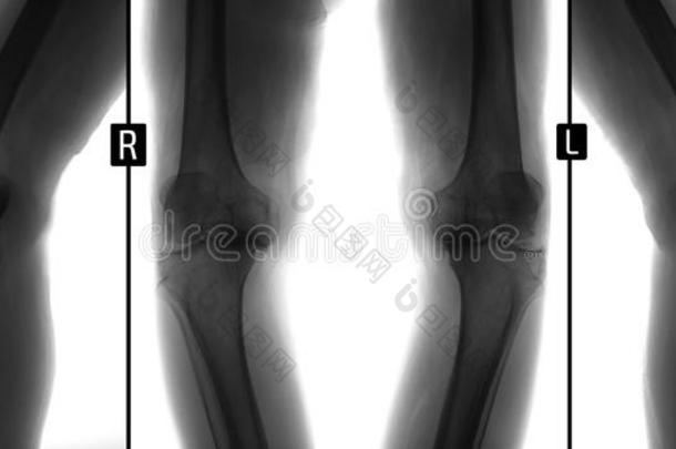 字母x-射线关于膝接头.使变形骨关节炎.消极的.