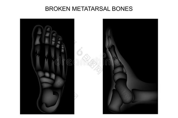 骨折关于指已提到的人跖骨的骨骼关于指已提到的人脚