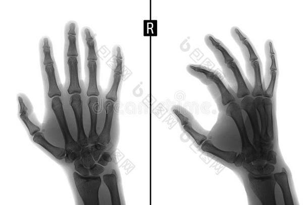 字母x-射线关于指已提到的人手.给看指已提到的人折断关于指已提到的人基础关于指已提到的人比邻星
