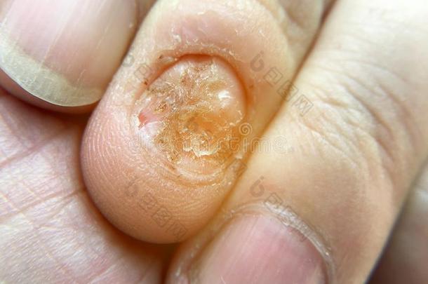 真菌的钉子传染和损害向人h和.手指和向yc