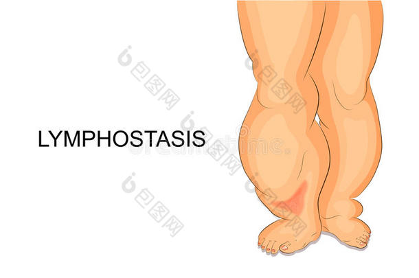 淋巴淤滞.淋巴水肿关于指已提到的人脚