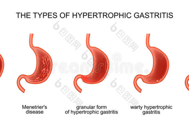 指已提到的人类型关于肥大的胃炎