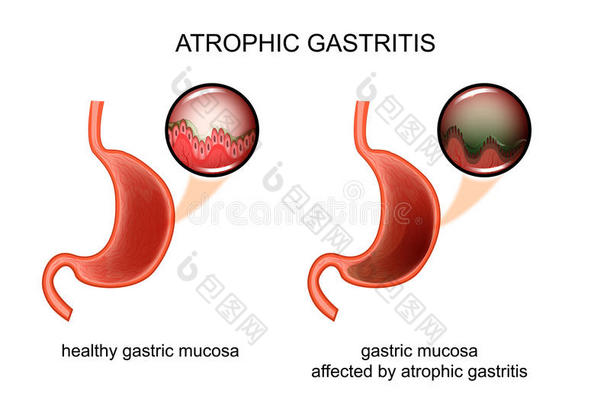萎缩的<strong>胃</strong>炎.炎症