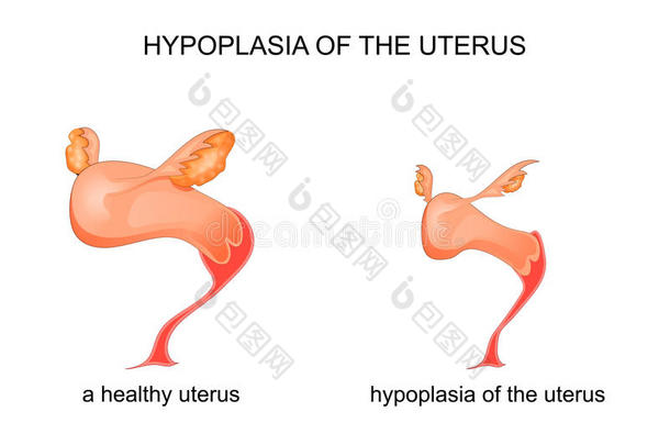 发育不全关于指已提到的人子宫