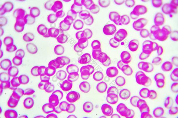 反常的红色的血细胞
