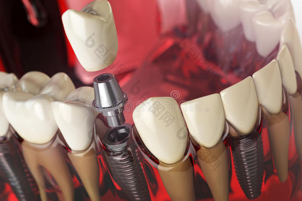牙移植物采用指已提到的人模型人牙,树胶和叮当声.牙本质