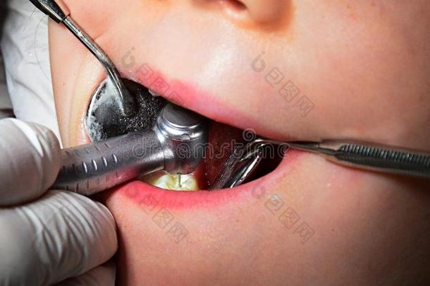 小儿科的口腔病学-磨关于磨碎的牙和白色的米林