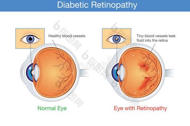 解剖关于正常<strong>的</strong>眼睛和<strong>糖尿病的</strong>视网膜病.