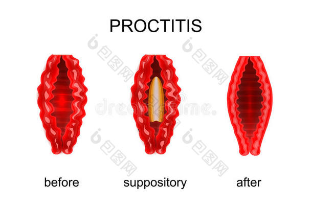 直肠炎.在之前和后的治疗关于直肠的栓剂