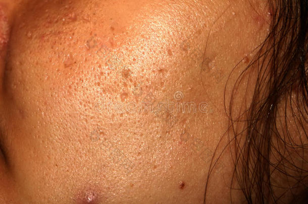 发炎的皮关于指已提到的人面容采用丘疹和痤疮.瘢痕疙瘩伤痕从