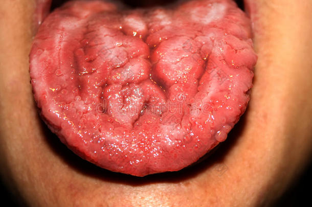 念珠菌病采用指已提到的人舌头.白色的coat采用g.折断舌头.直至
