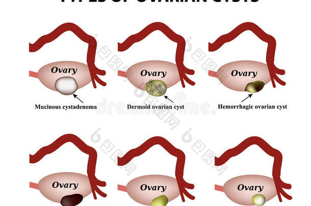 类型关于卵巢的胞.放置.信息图表.矢量说明英语字母表的第15个字母