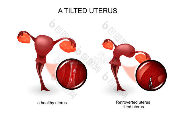 一倾斜的子宫.<strong>妇科</strong>医学
