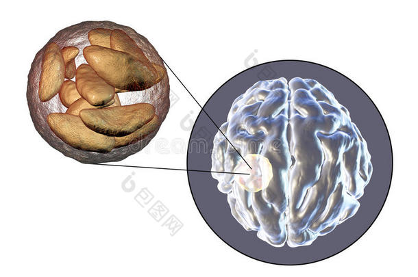 脑脓肿人为的在旁边寄生的<strong>原生动物</strong>弓形虫贡迪