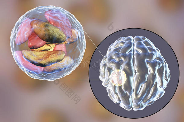 脑脓肿人为的在旁边寄生的<strong>原生动物</strong>弓形虫贡迪