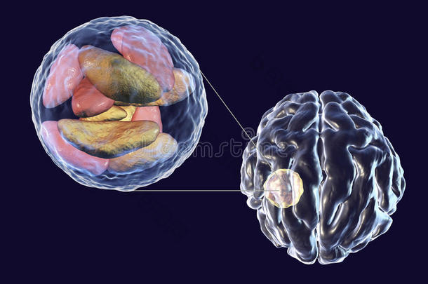 脑脓肿人为的在旁边寄生的原生动物弓形虫贡迪