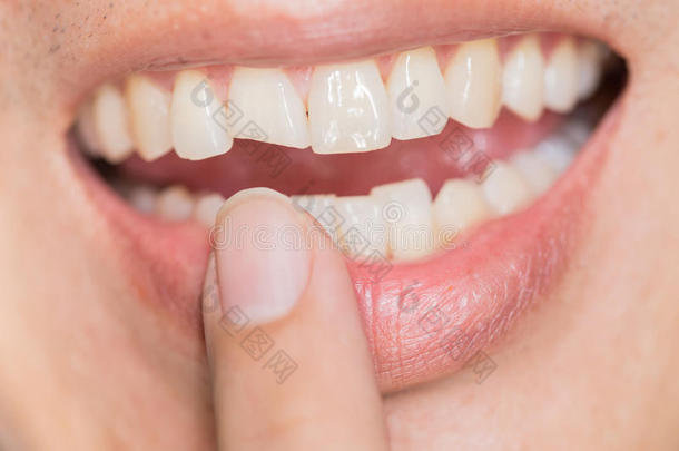 难看的微笑牙齿的问题.牙伤害或牙破坏采用英语字母表的第13个字母