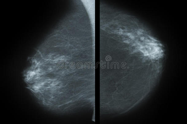 乳房X线照相术照片-字母x-射线关于乳房