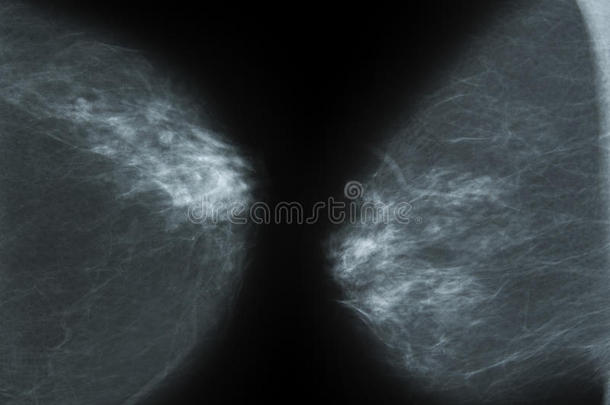 一乳房X线照相术照片-字母x-射线