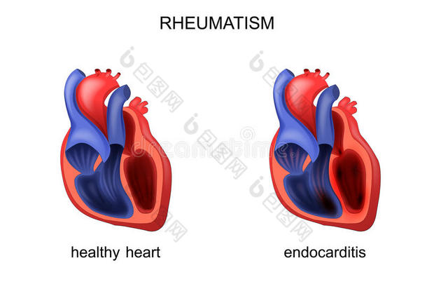 心健康的和患病的心<strong>内膜</strong>炎