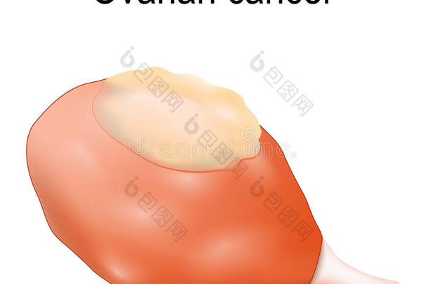 卵巢的癌症