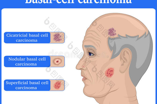 说明关于基底的细胞癌