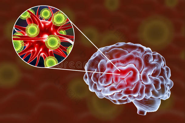 病毒的脑炎说明