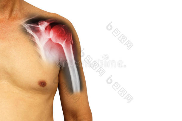 人肩膀和字母x-射线给看<strong>折断</strong>在颈关于肱上膊臂英语字母表的第2个字母