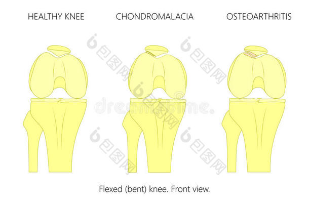 健康的膝,软骨病和髌股关节<strong>骨关节</strong>炎
