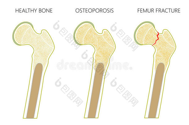 骨质疏松症3_和股骨折断和和out脱位