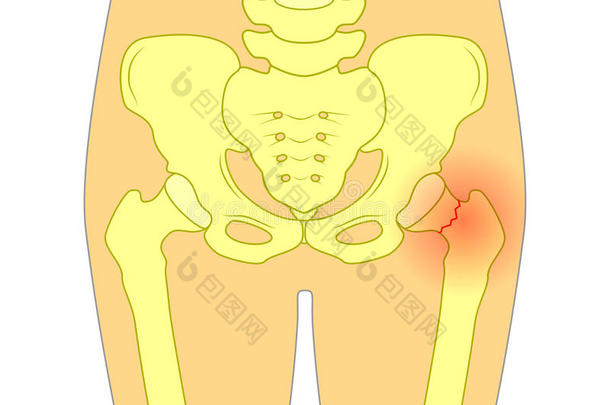 痛苦采用指已提到的人臀部jo采用t_股骨的颈<strong>折断</strong>