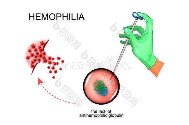 指已提到的人<strong>病理</strong>学的过程采用血友病